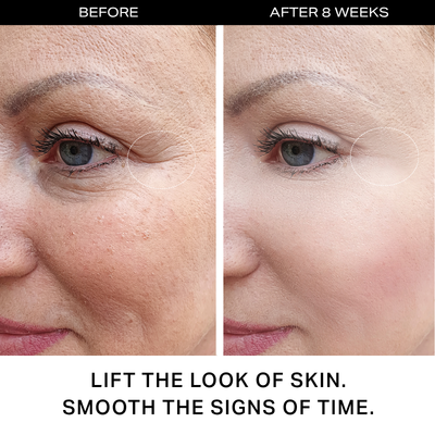 Y'OUR® Personalized Skincare System for Hormonal Acne