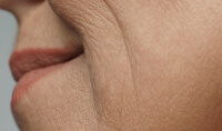 CLOGGED PORES