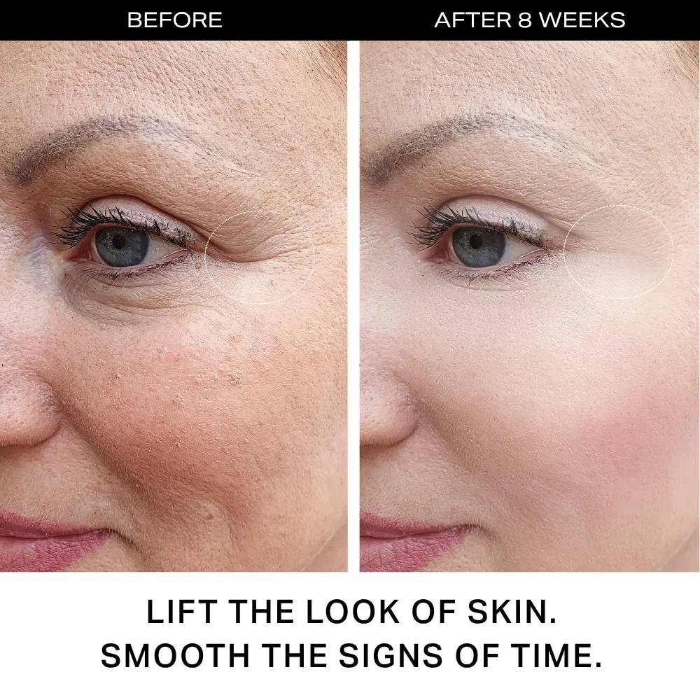Hormonal Acne Skin with Hydroxypinacolone Retinoate