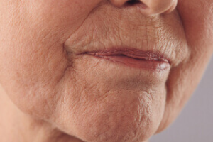Wrinkles