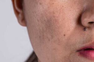 dull skin