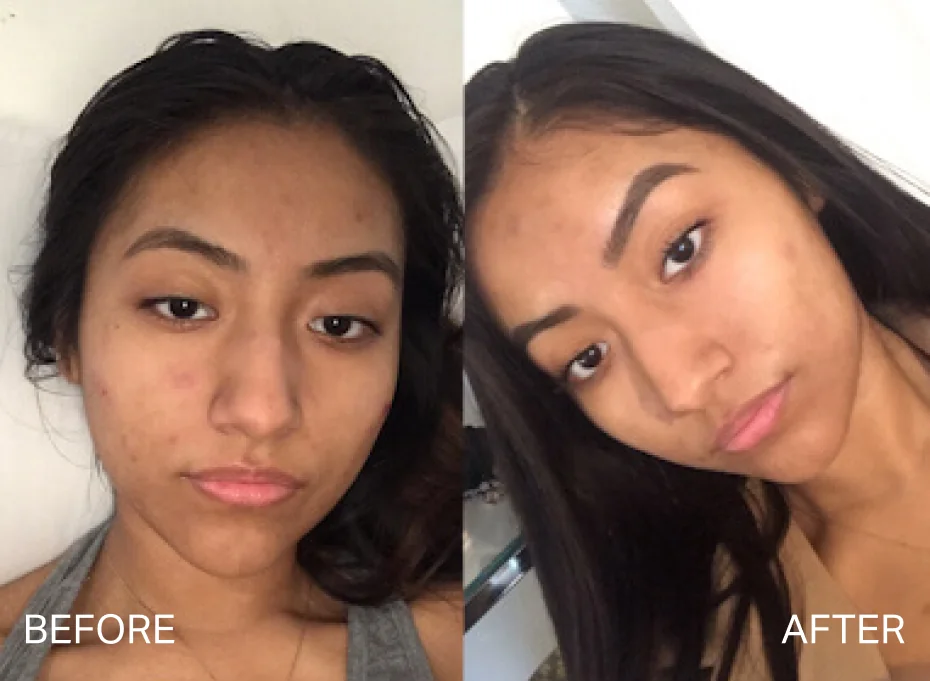 Before and after results for pigmentation and dark spots