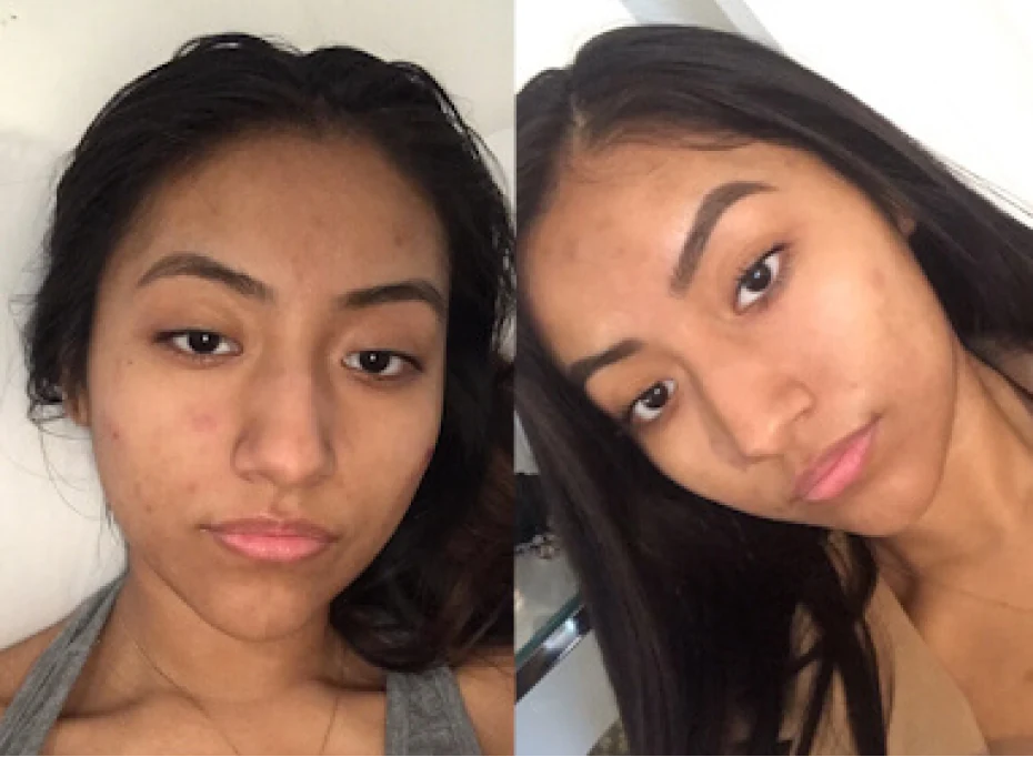 Before and after results for pigmentation and dark spots