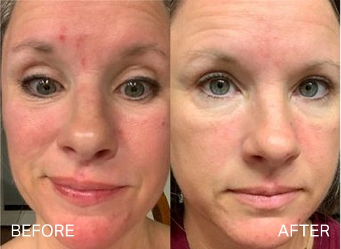 Before and after results for acne concerns