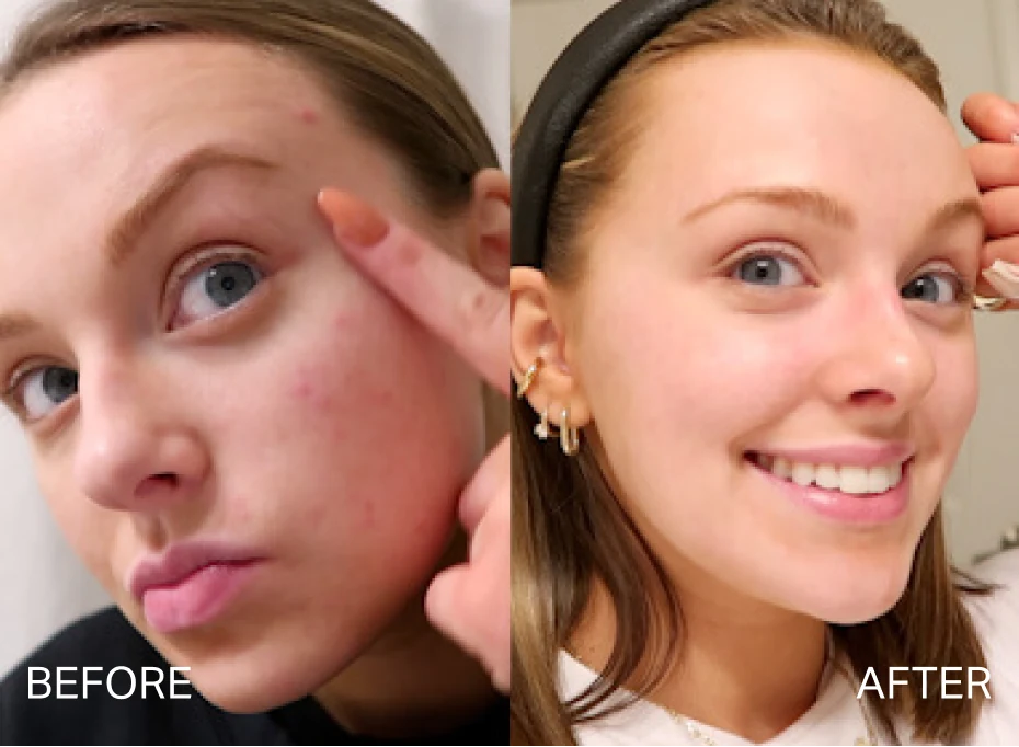 Before and after results for acne concerns