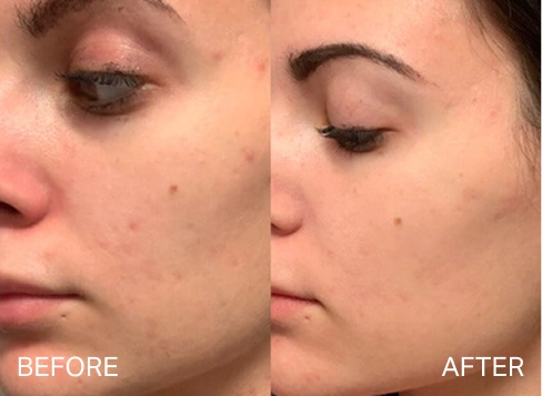 Before and after results for fine lines and wrinkles