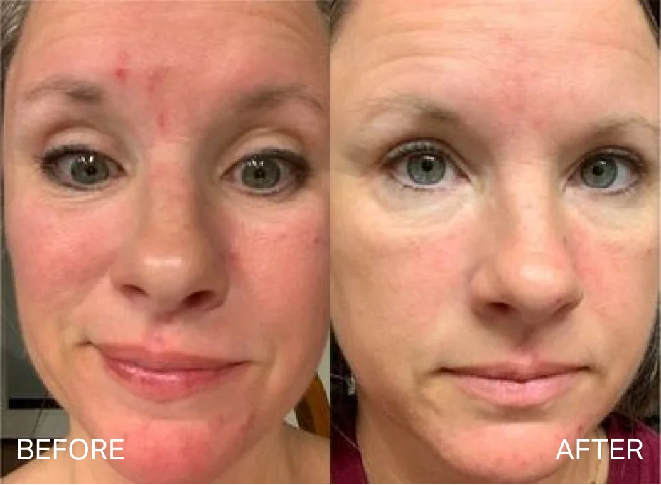 Before and after results for fine lines and wrinkles