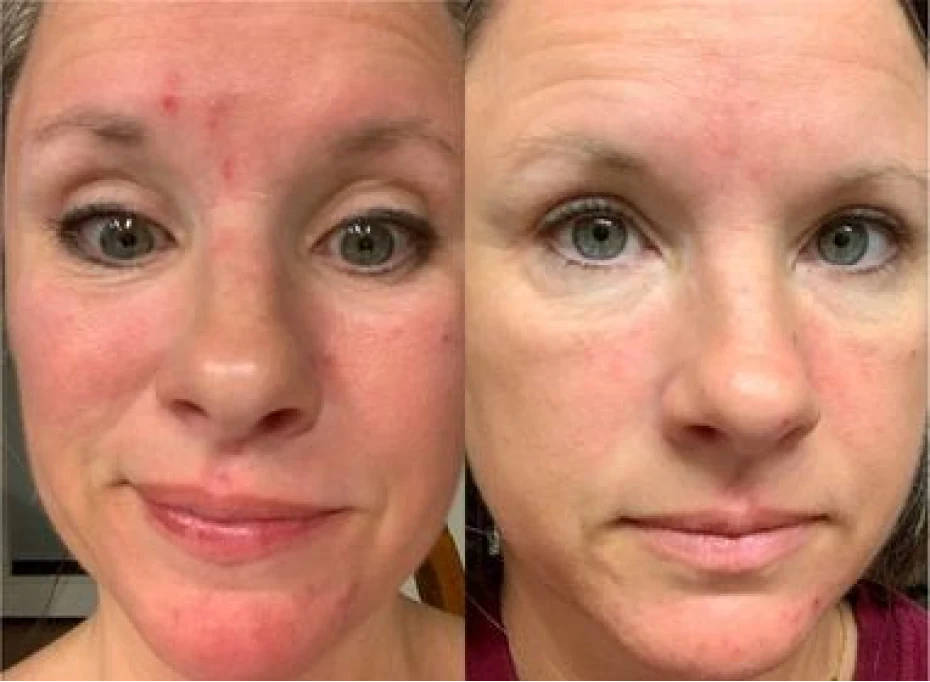 Before and after results for fine lines and wrinkles