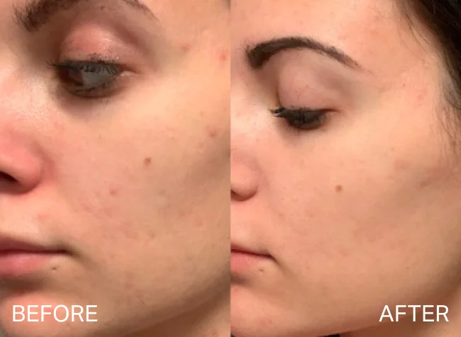 Before and after results for acne concerns