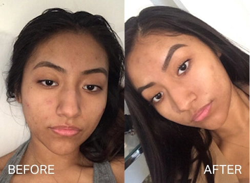 Before and after results for clogged pores